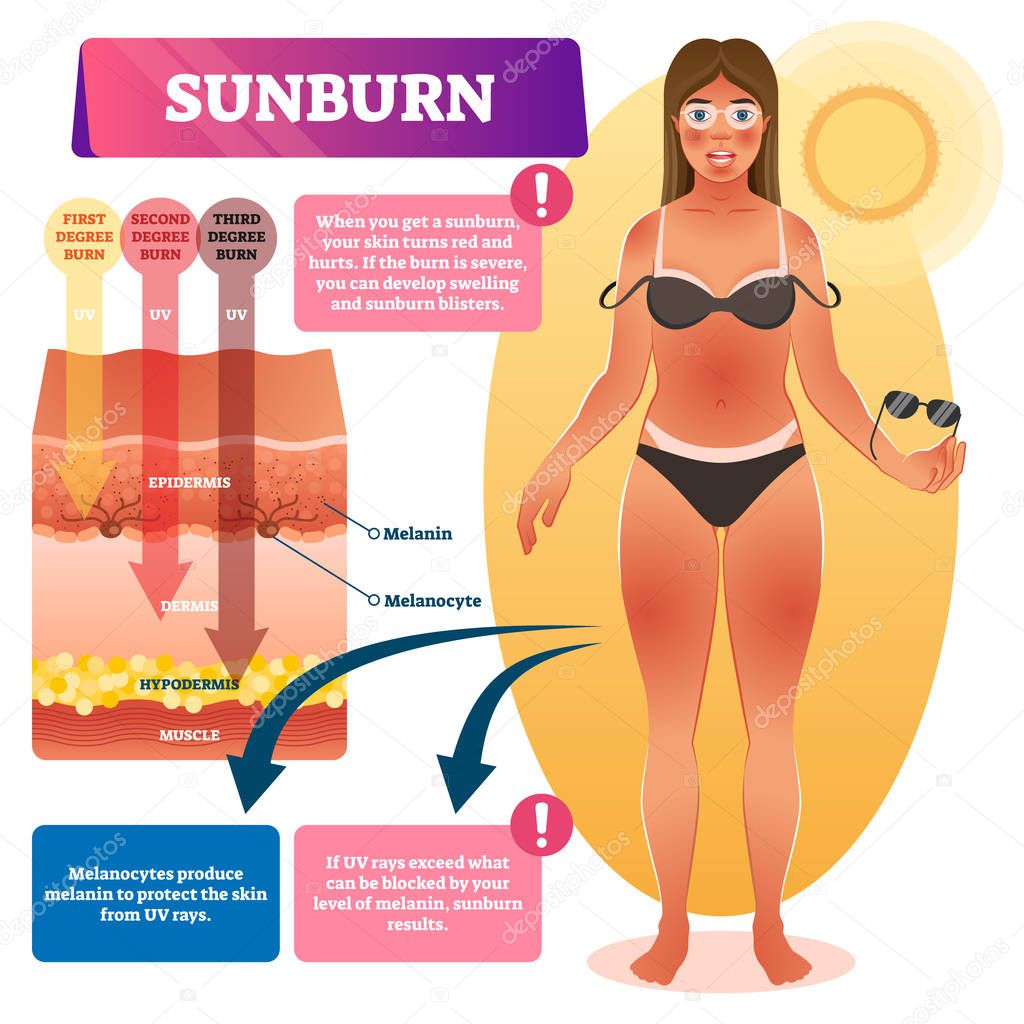 Sunburn vector illustration. Medical skin burn problem explanation scheme.