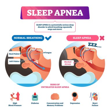Sleep apnea vector illustration. Labeled nasal tongue blocked airway scheme clipart