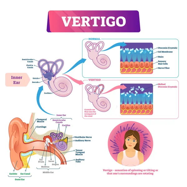 Illustrazione vettoriale della vertigine. Schema di problema dell'orecchio vestibolare medico etichettato . — Vettoriale Stock