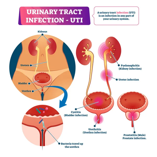 Urinary tract infection or UTI vector illustration. Labeled medical scheme. — Stock Illustration Urinary tract infection or UTI vector illustration. Labeled medical scheme. Stock Illustration