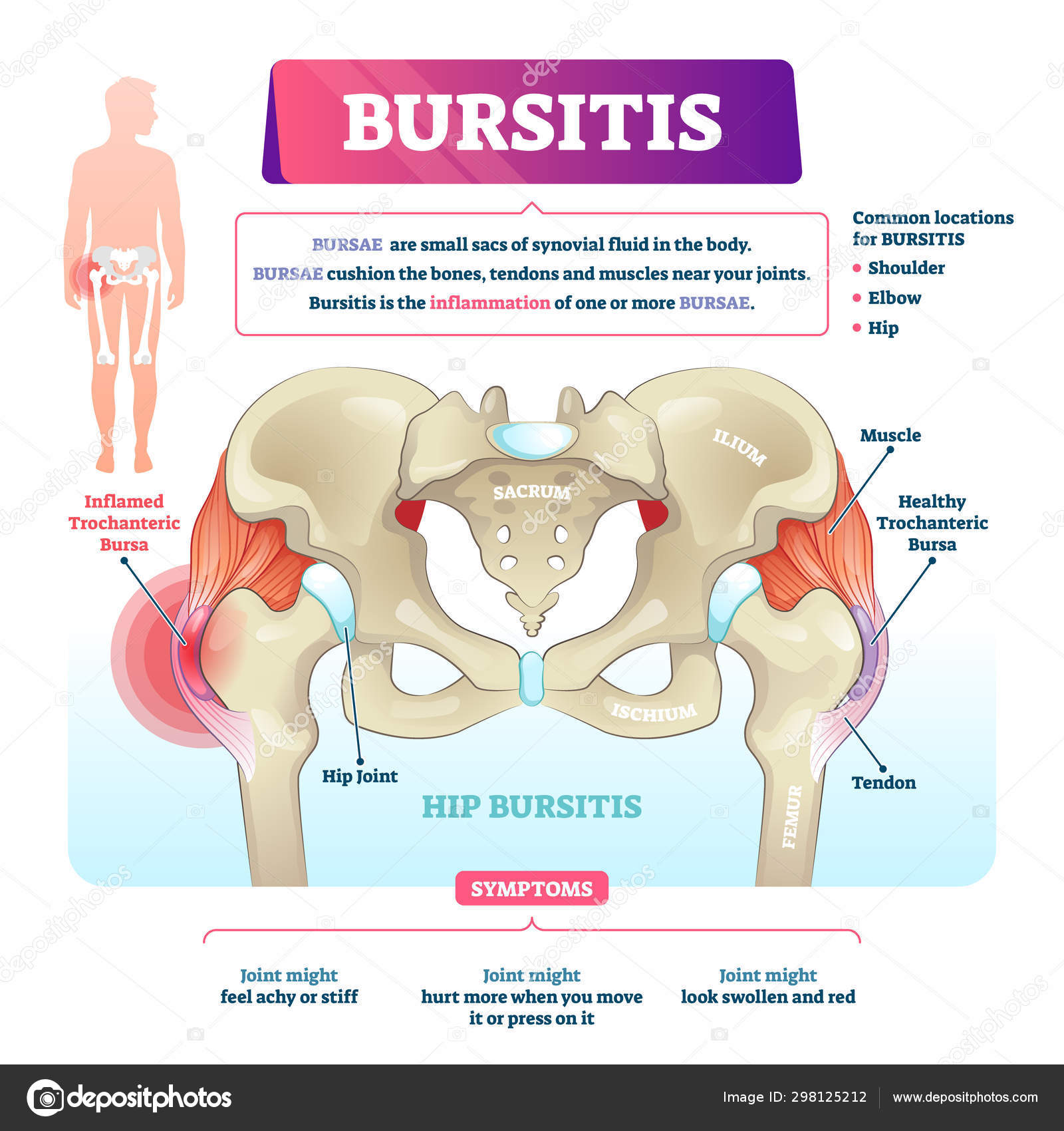 a bursitis gyulladása