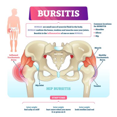 Bursitis vektör illüstrasyon. Etiketli bursae sinovyal inflamasyon şeması.