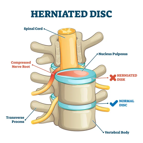 Falha de disco herniada Vista lateral 3D na ilustração vetorial do esqueleto ósseo da coluna vertebral —  Vetores de Stock