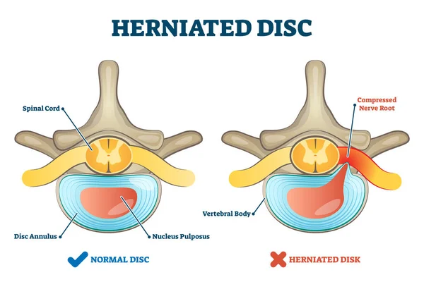 Hernia discal como ilustración vectorial de explicación de dolor espinal etiquetado — Archivo Imágenes Vectoriales