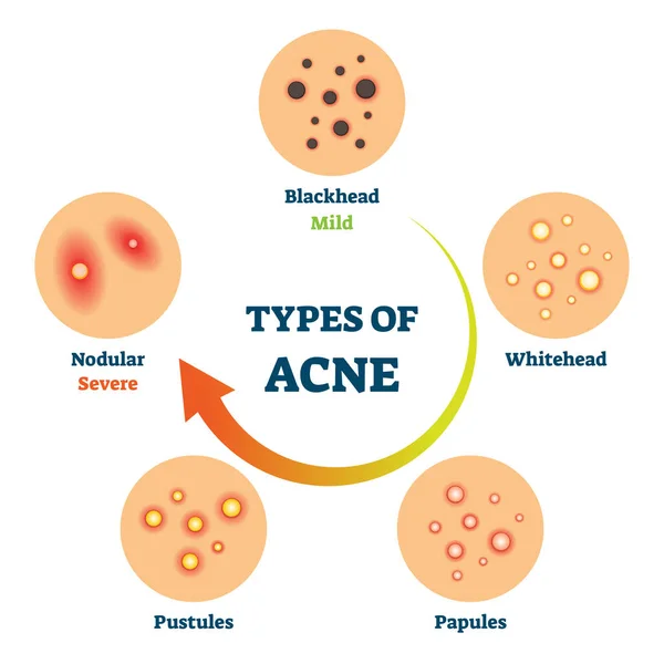 Tipos de acné como esquema de comparación de enfermedades de la piel médica ilustración vectorial — Archivo Imágenes Vectoriales