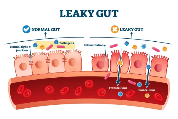 Síndrome de intestino goteante como explicación médica de la condición de inflamación crónica — Vector de stock