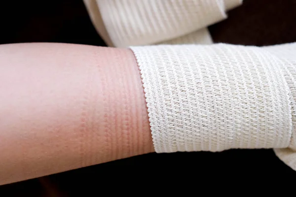 A pattern on the skin from a medical bandage. Removed the elastic bandage.
