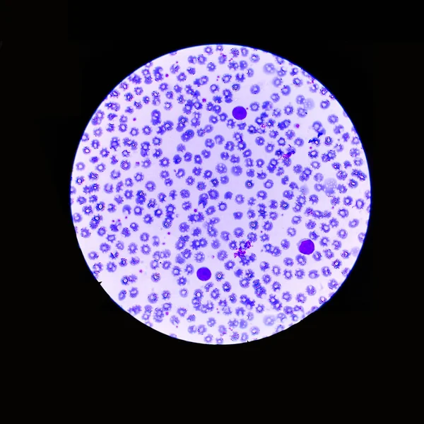 Формула Лейкоцитів Крові Визначення Великих Клітин Метод Живопису Який Видно — стокове фото