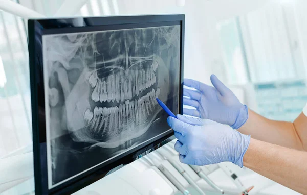 Eldivenli el doktoru diş röntgenini dijital ekranda, diş kliniğinde, arka planda tıbbi ekipmanlarla gösteriyor. Gülümse sağlıklı diş konsepti, kapat.