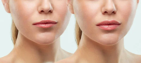 Antes y después de las inyecciones de relleno de labios. Plástico de belleza. Hermosos labios perfectos con maquillaje natural . —  Fotos de Stock