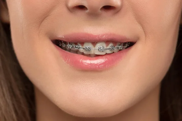 Güzel genç kadın diş diş teli ile — Stok fotoğraf