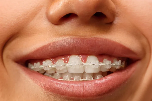 Bella giovane donna con denti bretelle — Foto Stock