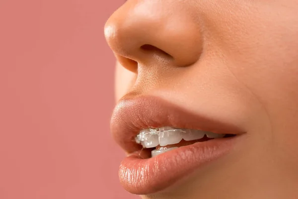 치아 교정기와 아름 다운 젊은 여자 — 스톡 사진