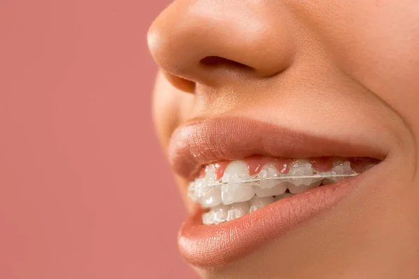 Mulher bonita com aparelho de dentes — Fotografia de Stock