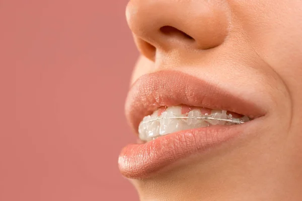 Gyönyörű fiatal nő, fogak fogszabályozó — Stock Fotó