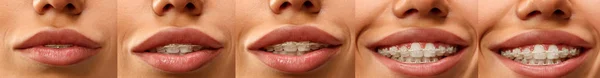 Mooie jonge vrouw met tanden bretels — Stockfoto