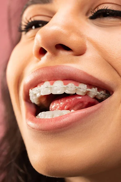 Gyönyörű fiatal nő, fogak fogszabályozó — Stock Fotó