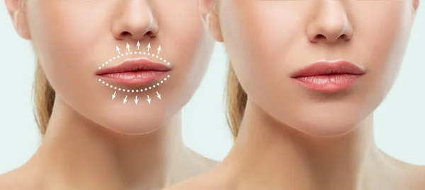 Voor en na de lippen filler injecties. Schoonheid kunststof. Mooie perfect lippen met natuurlijke make-up. — Stockfoto