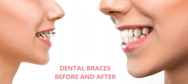 Zbliżenie kobiecy portret, szelki dentystyczne przed i po — Zdjęcie stockowe
