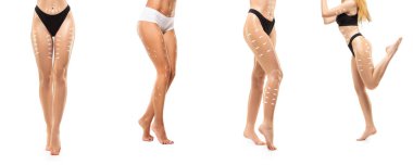 Selülit çıkarma planı. Estetik ameliyata hazırlanan genç kadın vücudundaki kara lekeler. Vücut düzeltmesi kavramı