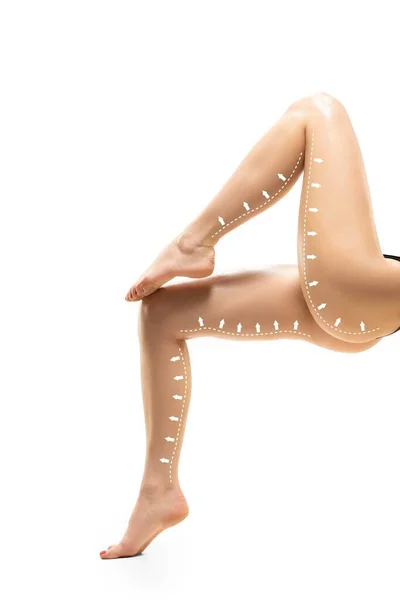 Plan zur Entfernung von Cellulite. Die schwarzen Markierungen auf dem Körper der jungen Frau, die sich auf eine Schönheitsoperation vorbereitet. Konzept der Körperkorrektur — Stockfoto