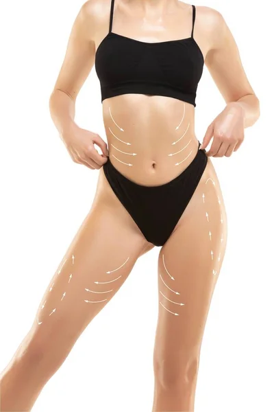Plan zur Entfernung von Cellulite. Die schwarzen Markierungen auf dem Körper der jungen Frau, die sich auf eine Schönheitsoperation vorbereitet. Konzept der Körperkorrektur — Stockfoto
