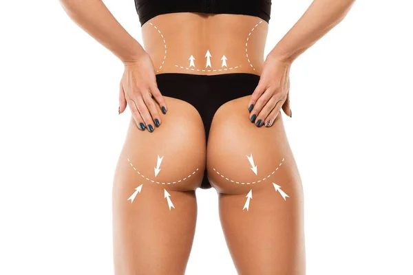 Plan zur Entfernung von Cellulite. Die schwarzen Markierungen auf dem Körper der jungen Frau, die sich auf eine Schönheitsoperation vorbereitet. Konzept der Körperkorrektur — Stockfoto