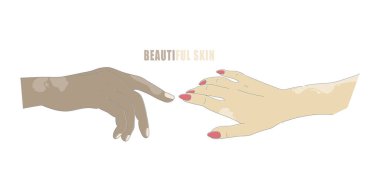 Yaş noktaları olan eller ya da vitiligo izole vektörü. Genetik deri hastalığıyla el hareketleri. Manikürlü kadın elleri.