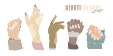 Yaş noktaları olan eller ya da vitiligo izole vektörü. Genetik deri hastalığıyla el hareketleri. Manikürlü kadın elleri.