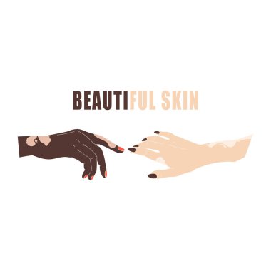 Yaş noktaları olan eller ya da vitiligo izole vektörü. Genetik deri hastalığıyla el hareketleri. Manikürlü kadın elleri.