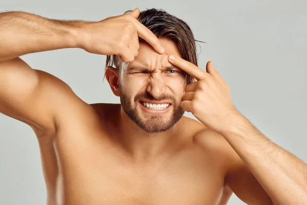 Acne spot espinha spot skincare beleza cuidado masculino pressionando no rosto problema de pele . — Fotografia de Stock
