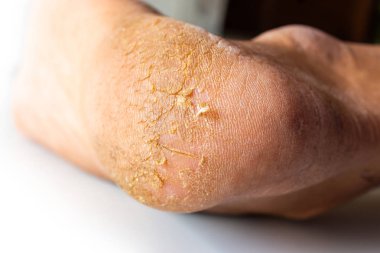 Topuklu ayakkabılarla çatlak deri. Ayakların kuru cilt.