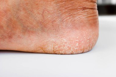 Topuklu ayakkabılarla çatlak deri. Ayakların kuru cilt.