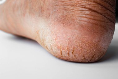 Topuklu ayakkabılarla çatlak deri. Ayakların kuru cilt.