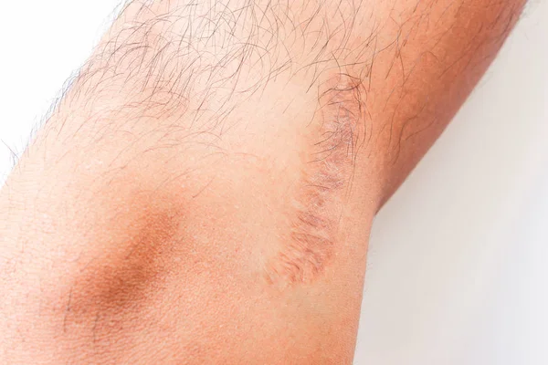 Una Cicatrice Cicatrici Sulla Pelle — Foto Stock