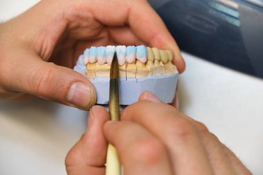 Diş hekimi takma diş çene 3d baskılı ellerini tutar. Gelecekteki kaplama diş kliniğinde şekli hastaya bakar