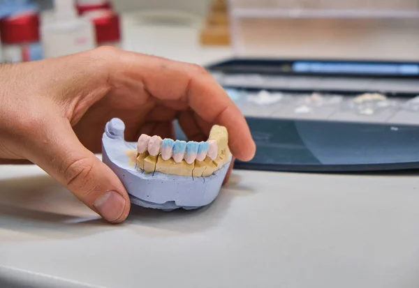 Dientes Artificiales Prótesis Manos Mientras Trabaja Prótesis Dental Dientes Postizos — Foto de Stock