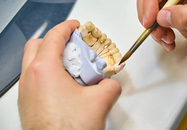 技师牙科与完整的上 下金属陶瓷假牙一起工作 牙科医生用牙刷和牙龈模型工作 — 图库照片