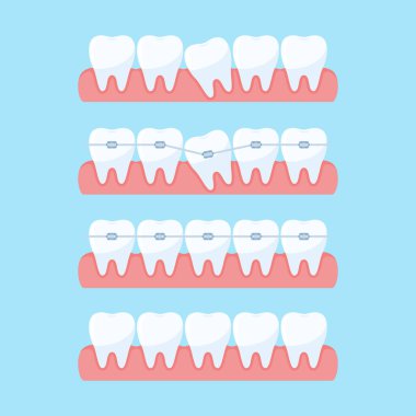 Diş hizalama aşamaları
