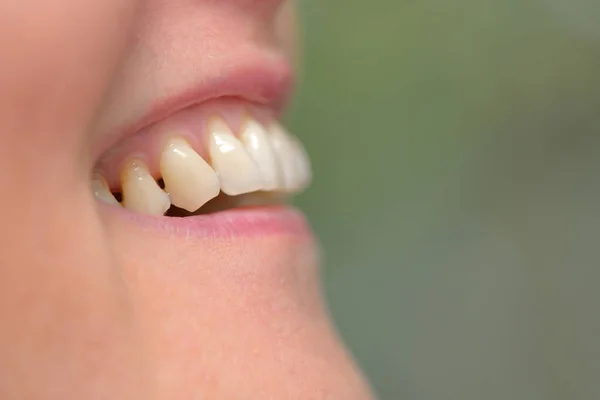 Detail Woman Teeth Parodontose — Stock Photo, Image