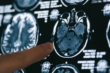 Beynin manyetik rezonans görüntüsüne işaret ediyor. MRI kafa taraması. Tıp, bilim konsepti 