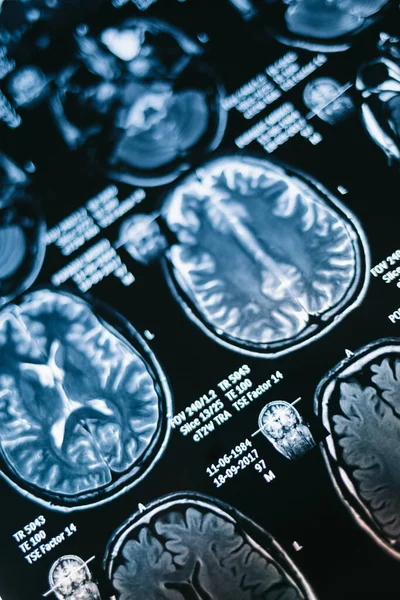 Магнітно Резонансне Сканування Мозку Сканування Голови Мрт Медицина Наука — стокове фото