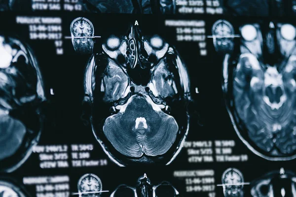 脑部磁共振扫描 Mri头扫描 — 图库照片