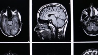 Manyetik rezonans görüntüleme, çoklu MRI beyin taraması.