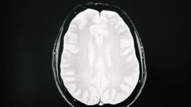 Manyetik rezonans görüntüleme, çoklu MRI beyin taraması.