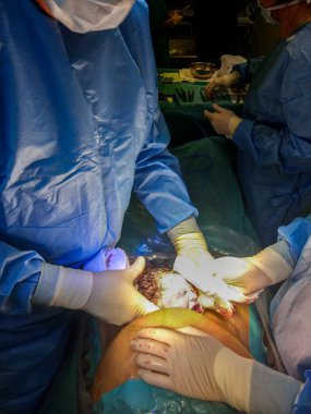 Bir kadın doğum yaptığı anda doğum odası - sezaryen - yaşamasına saniyeler kalmış bir kız