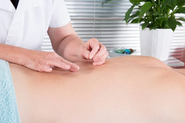 Medicina Alternativa Primer Plano Espalda Masculina Con Agujas Acero Durante — Foto de Stock