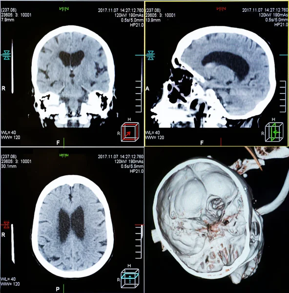 Magnetic resonance imaging (MRI) scan - CT scans of human head on a ultrasound computer monitor.