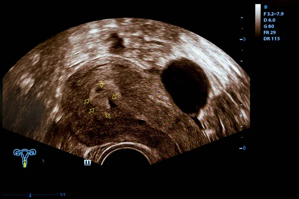 Imagen colorida del monitor de ultrasonido del embarazo — Foto de Stock