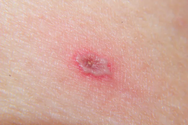 Close-up de varicela (varicela) na pele na fase final — Fotografia de Stock